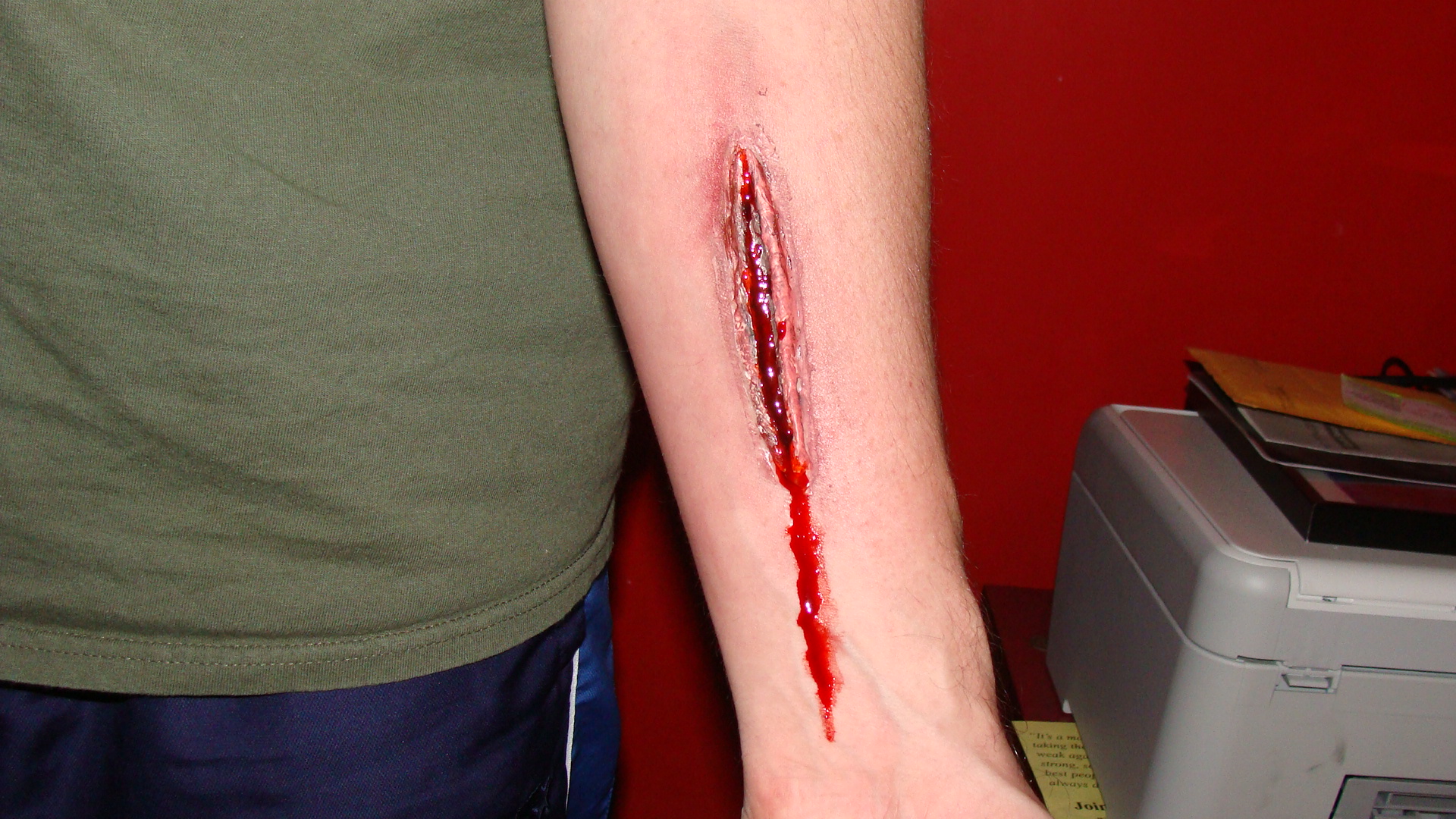 Arm Wounds
